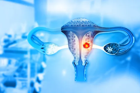 illustration of womb cancer