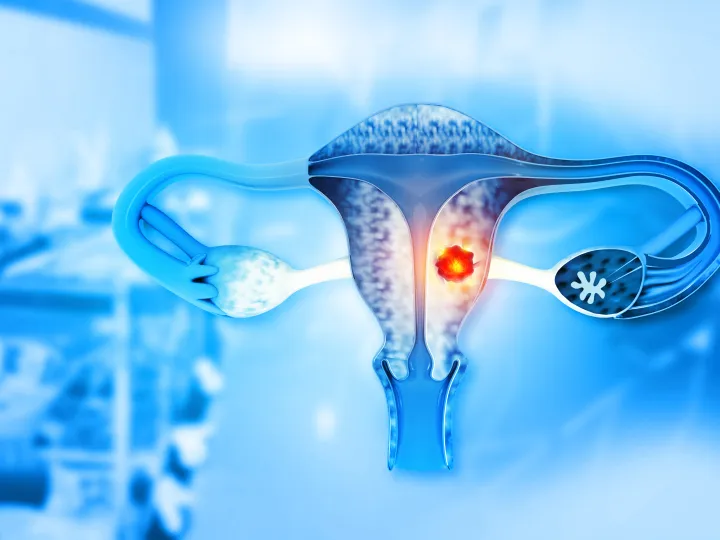 illustration of womb cancer